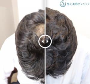 聖心毛髪再生外来