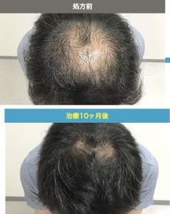 AGAオンクリ　症例写真