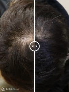 聖心毛髪再生外来
