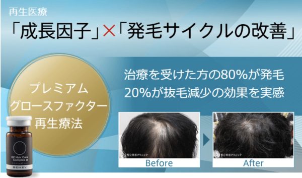 毛髪再生外来