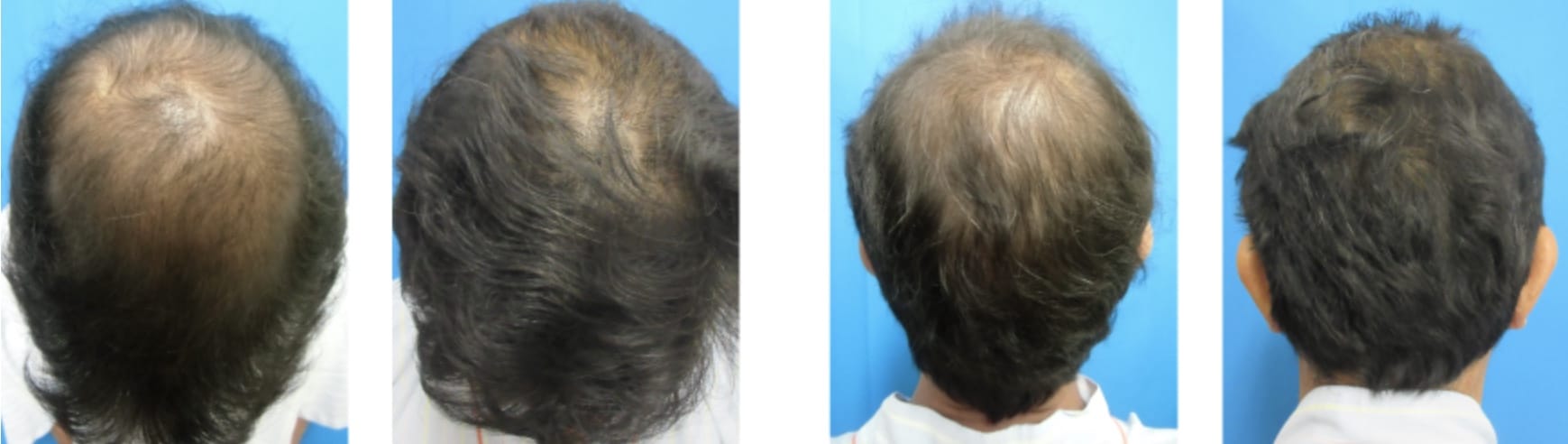 ガーデンクリニック発毛医療外来